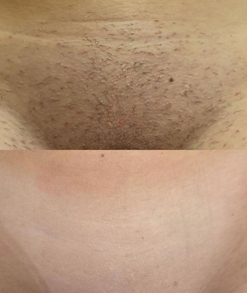 laser hair removal for sensitive skin