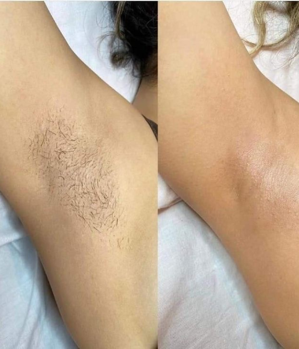 laser hair removal for armpits