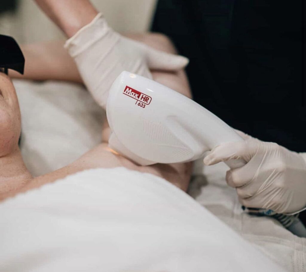 Hair Removal with SharpLight’s Long Pulse Laser
