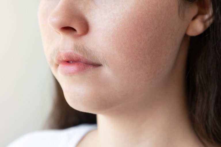 Bid Farewell to Hormonal Hair Woes with SharpLight’s Long Pulse Laser at NewBody NL
