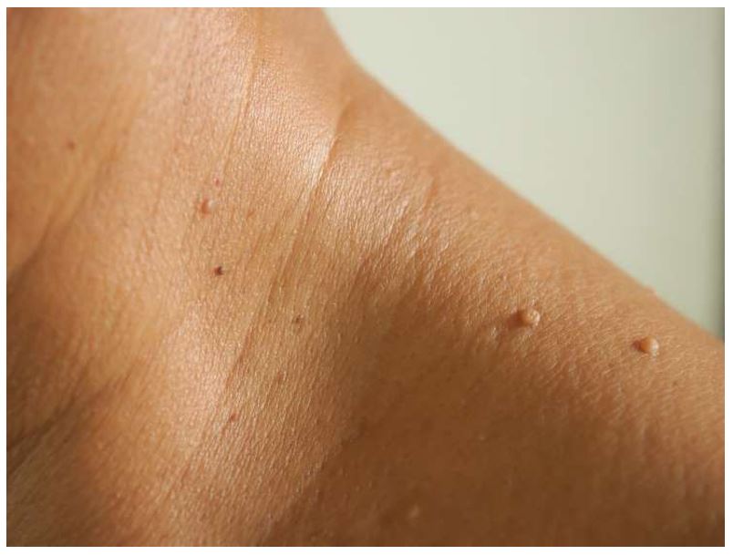 SharpLight’s Long Pulse Laser for Skin Tags