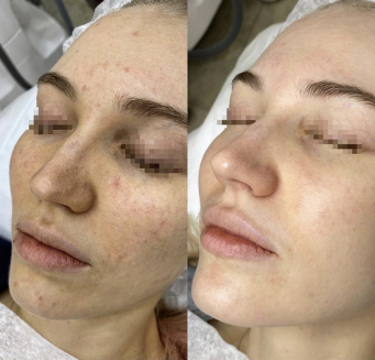 The Hollywood Facial: Discover the Celebrity Secret with SharpLight’s Carbon Facial Peel at NewBody NL