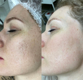 The Hollywood Facial