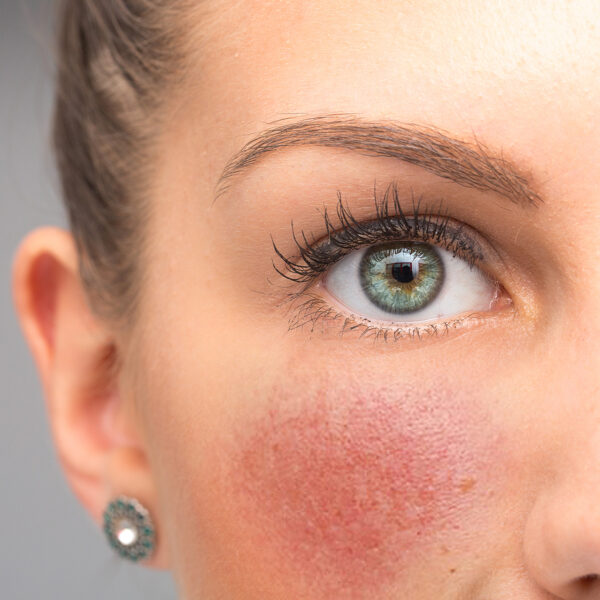 BioRosacea Anti-Redness Gel - Image 2
